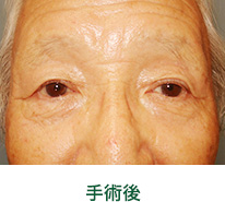 眼瞼下垂　例4　　手術後　松山　眼科　たてまつ眼科　松山市　愛媛　愛媛県