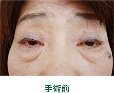 眼瞼下垂　例2　手術前　松山　眼科　たてまつ眼科　松山市　愛媛　愛媛県
